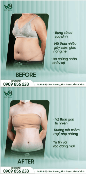 Before & After - Hút mỡ