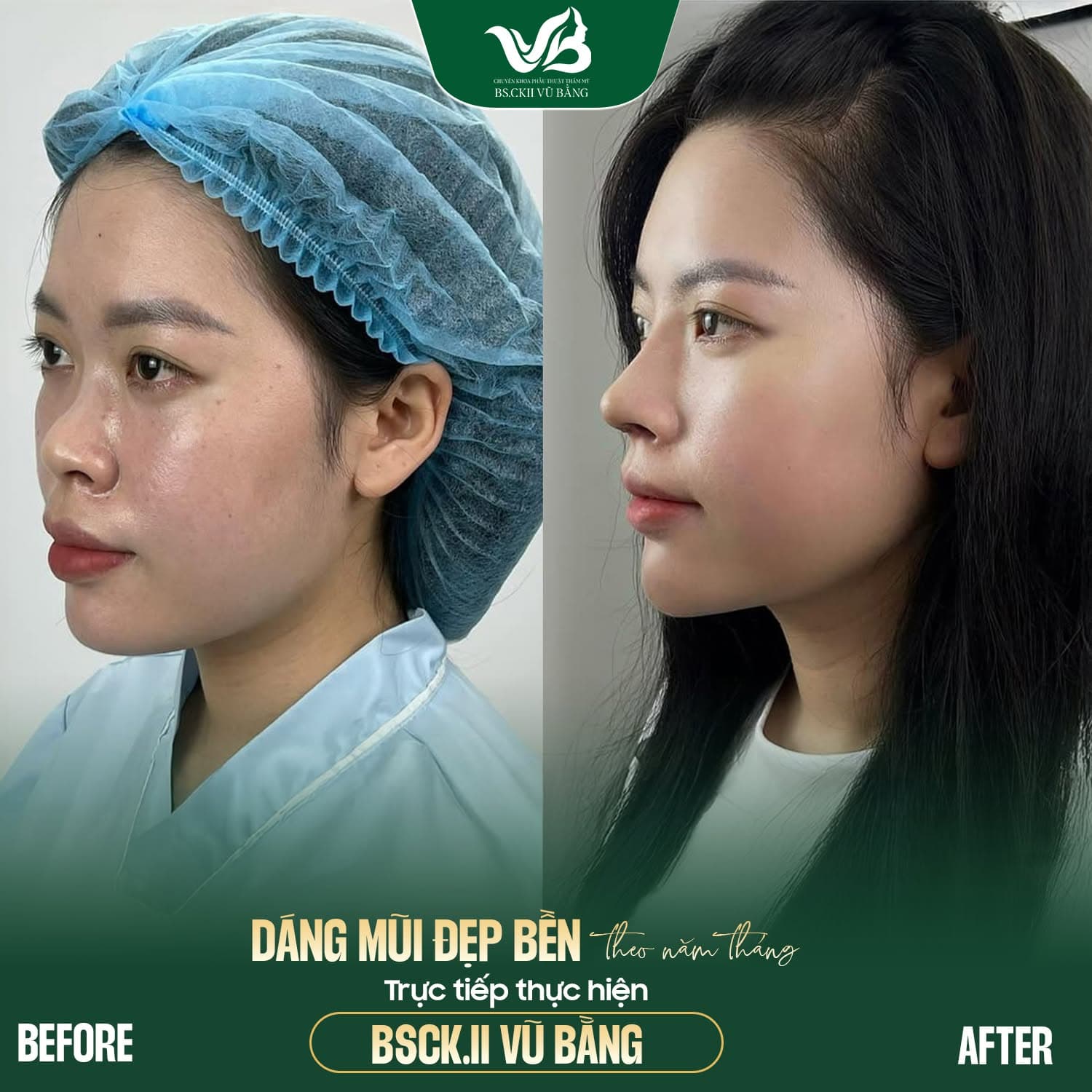 Before & After - Nâng mũi